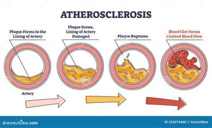 Does atherosclerosis cause low blood pressure