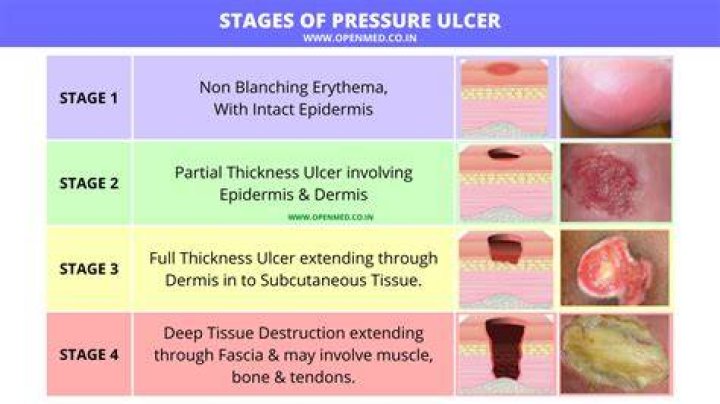 How do pressure ulcers form