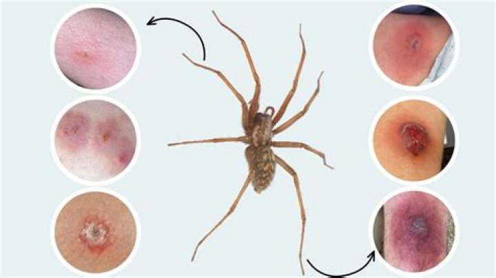 How do you get rid of a spider bite on your face