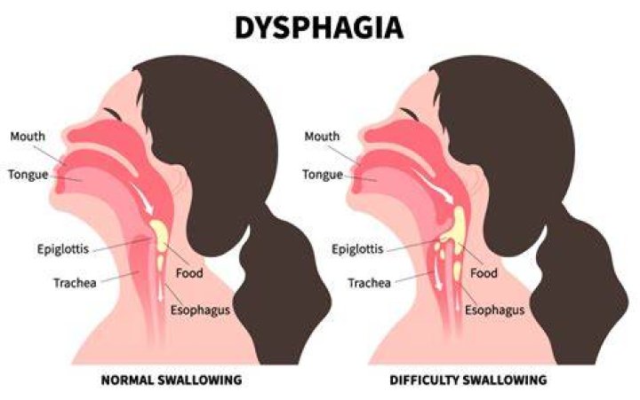 How do you treat dysphagia at home