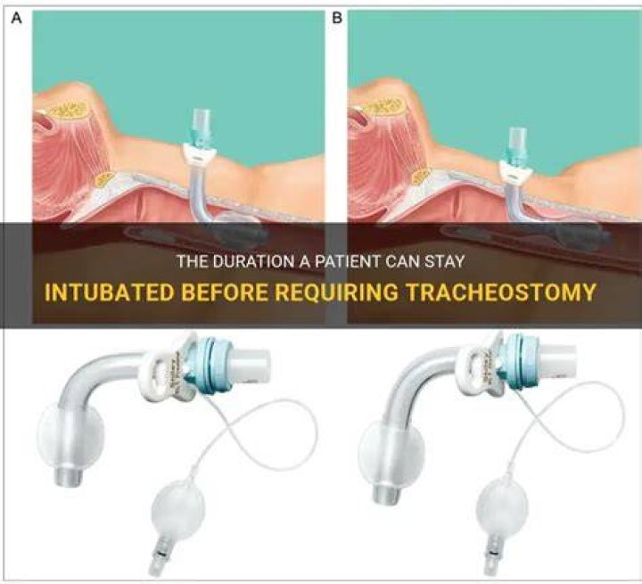 How long can a patient be intubated before tracheostomy