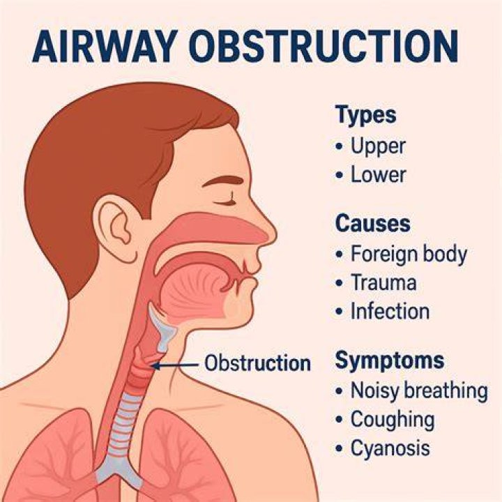 What are the four most common causes of airway obstruction