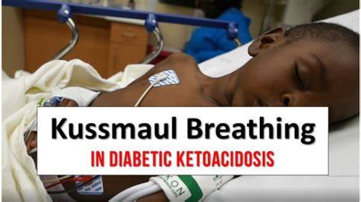What causes Kussmaul breathing in DKA