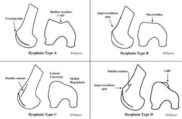 What causes Trochlear dysplasia