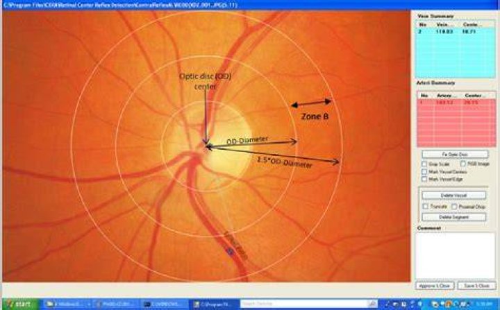 What is arteriolar light reflex