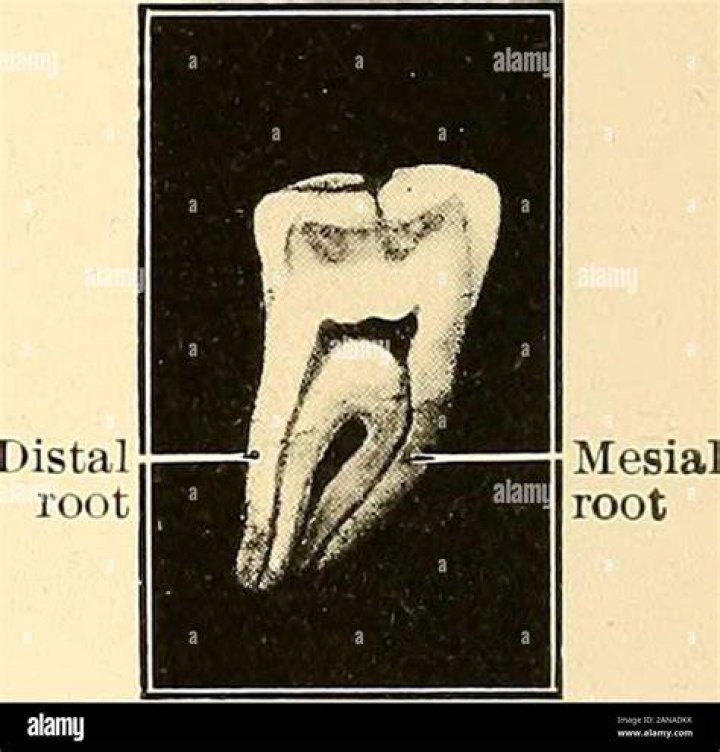 What is mesial root