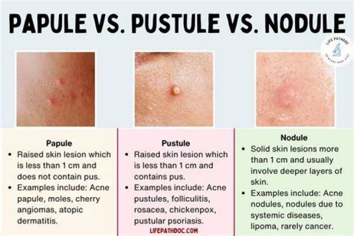 What is the difference between a vesicle and a pustule